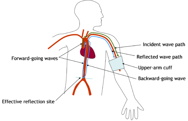 Pressure wave reflection in the arterial system